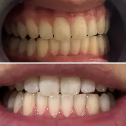 【メンズ限定】セルフホワイトニング