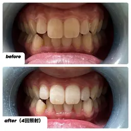 セルフホワイトニング1回