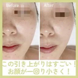 INDIBA フェイシャル