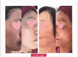 【モニター価格◎】たるみ改善コース60分