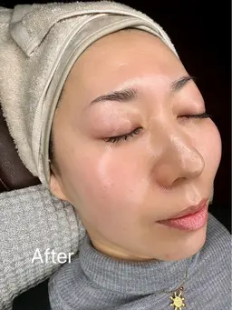 全顔フェイスワックス＋うなじワックス（集中保湿トリートメント付き）¥7,500→¥7,000