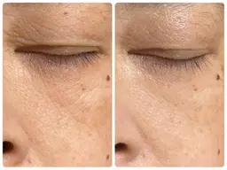 【機器とパックで集中エステ】トラブル改善！