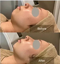 【初回限定】マイクロ波温熱オンリフト1部位（引き締め）