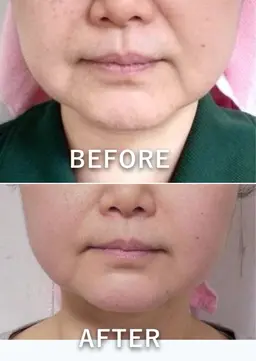 🩵ふっくら艶肌🩵5Ｄラジオ波フェイシャル✨️