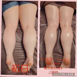 浮腫んだ足をスッキリ✨下半身痩せ　キャビテーション+ラジオ波+EMS吸引