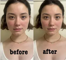 学割👩🎓🌸【最強小顔、とにかくスッキリ】✨電気美容鍼+強力EMS✨/特別価格13800円→5900円