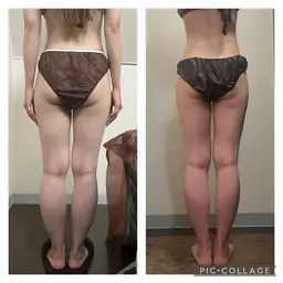 モデル様募集🌿ハイパーナイフ✖️脚痩せ&ヒップアップ⤴️