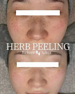 【結果重視したい方(30%off)】iLLONハーブピーリング×ホームケア/月額52,100円→37,600円‼️