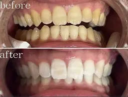 「歯が白いだけで、第一印象は変わる。」セルフホワイトニング