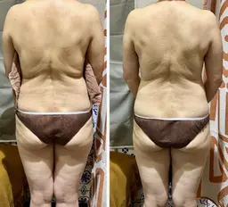 キャビテーションダイエットモニター２パーツ