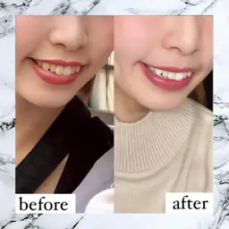 🌟セルフホワイトニング🌟学割初回体験10分×3回　​〜​安心のカウンセリング付き​〜​