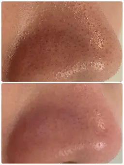 ハイドロスプラッシュ/Tゾーンポイントケア