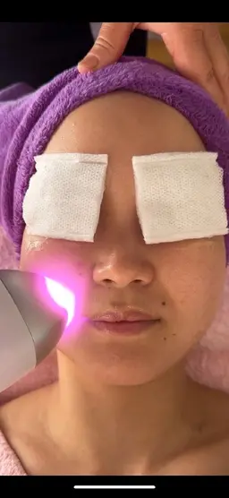 最新LED脱毛　鼻の産毛だけ脱毛したい方に朗報❗体験爆安ミニモキャンペーン