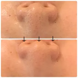 小鼻の黒ずみに☆小鼻ハーブピーリング