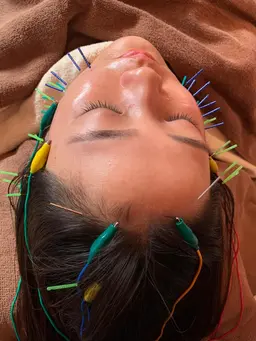 【🎅クリスマス限定価格🎄✨】スタンダード美容鍼(美容鍼🪡×指圧マッサージ)