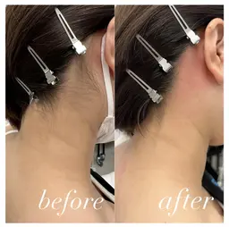 【うなじワックス脱毛】🤍ྀི角質も一緒にケアしてツルスベ肌に✨トーンアップ効果🫧