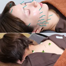 【minimo限定】お顔も身体も気になる方オススメ🌟美容整体コース６０分(美容鍼+微弱電流+整体マッサージ)