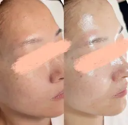 【圧倒的人気No.１✨】ララピールの進化版、乳酸菌配合セラピール＋IPLフォト＋セラパック