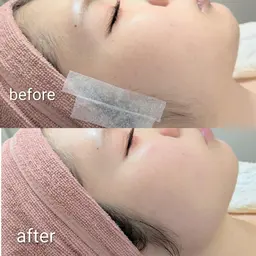 【つるん肌】フェイシャルWAX脱毛