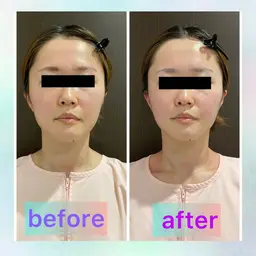 モニター価格‼️【人気No.１韓流コルギ】スッキリ小顔に！お顔の土台ケア　お一人様1回限り！
