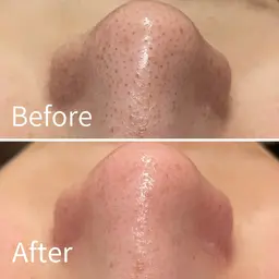 【平日16：00まで初回】ハイドロ毛穴洗浄×イオン導入　¥11,000→¥ 5,980【口コミ割】