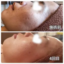 明日1/17(土)限定価格❣️\敏感肌OK｜やさしい肌育ハーブピーリング(剥離なし)🌿/