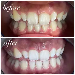 🏫セルフホワイトニング🏫学割‼️初回体験10分x3回 ～安心のカウンセリング付き​〜​