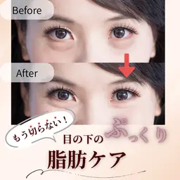 もう切らない！目の下のぷっくり脂肪ケア《体験2回》