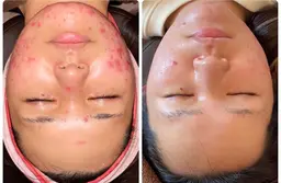 ✨🌿FLEUR8周年特別メニュー🌿✨全顔ケア剥離ハーブピーリング🌿✨医療クリニック提携サロン🏥