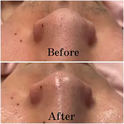 【🌟スペシャル毛穴汚れザラつき僕滅メニュー🌟】お顔剃り＋全顔毛穴洗浄＋ハイドロジェリーマスク