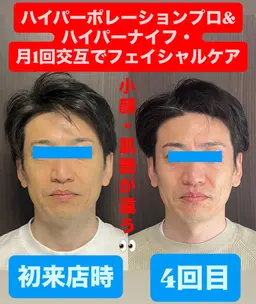 フェイシャル【小顔NO1】二重顎・たるみケア＆脂肪・浮腫み撃退　¥8800→¥8000