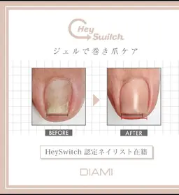 👣フット専用👣　巻き爪ケア