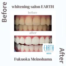 【お試しプラン】美白ホワイトニング10回コース　20分×10回　基本的には5日分