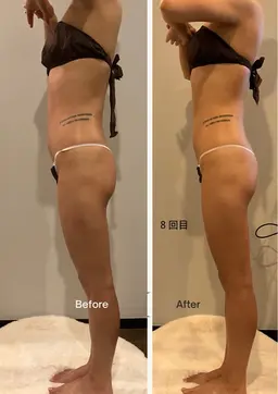 [美脚*美尻集中コース]ハイパーナイフEx+リンパマッサージ60分