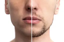 🉐痛くない！メンズヒゲ脱毛11回コース😊