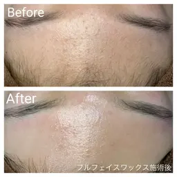 ⭐️選べるお好きな3パーツ⭐️艶肌フェイスワックス60分(鼻・眉間・顎・鼻下)の中から選択可能