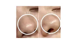 24日限定⭐️【お顔まるごと脱毛】フェイシャルワックス