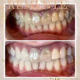 【ホワイトニング】歯科医監修溶剤で30分照射パワー100%🦷時短で歯周病予防にも効果あり✨