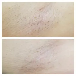 【中学生&高校生だけ！★10分脱毛★両脇】