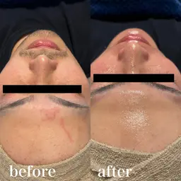 【男性】フェイシャル前顔