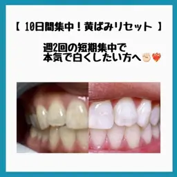 🦷新世代🪥歯のセルフホワイトニング