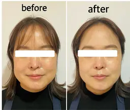 痛くない小顔矯正