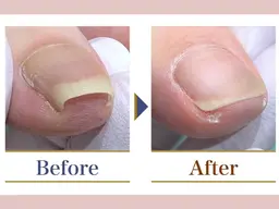 【巻き爪1箇所】痛みがある方！痛みがなくても巻きが強い方！！専用の器具で優しく、効果的な施術をいたします。