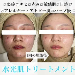 ニキビ撲滅👊🫧レストセルトリートメント 《マッサージ有》🫧炎症ニキビ/敏感肌/日焼け/アレルギー/アトピー肌