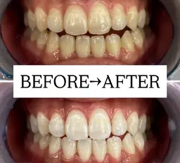 【当日に回数券ご購入の方】初回無料★美白ホワイトニング20分×2回照射が無料✨