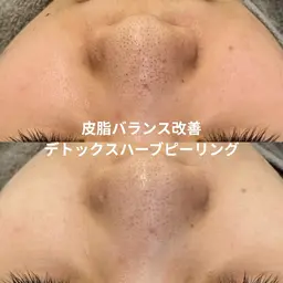 🌿今だけの特別メニュー‬🌿‬毛穴洗浄×ハーブピーリング｜毛穴・ザラつき・ニキビ特化ケア