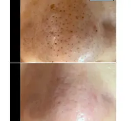 【初回】メンズ専門『イチゴ鼻撃退』韓国式毛穴洗浄(お試し鼻プラン)