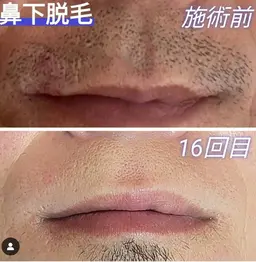 お試し髭脱毛(鼻下、あご、首、もみあげ、頬、)全て