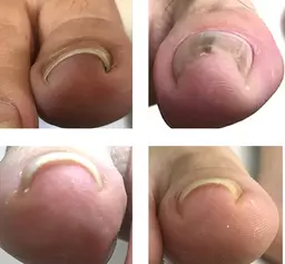 巻き爪ケアが初めてな方：足爪巻き爪ケア（2本まで）のみ　※足爪全体のフットケアなしシンプルメニュー