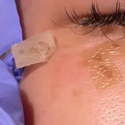 【15分取り放題】機械を使わないシミケア「ホワイトラボ」¥33,000→¥16,500